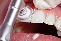polishing teeth